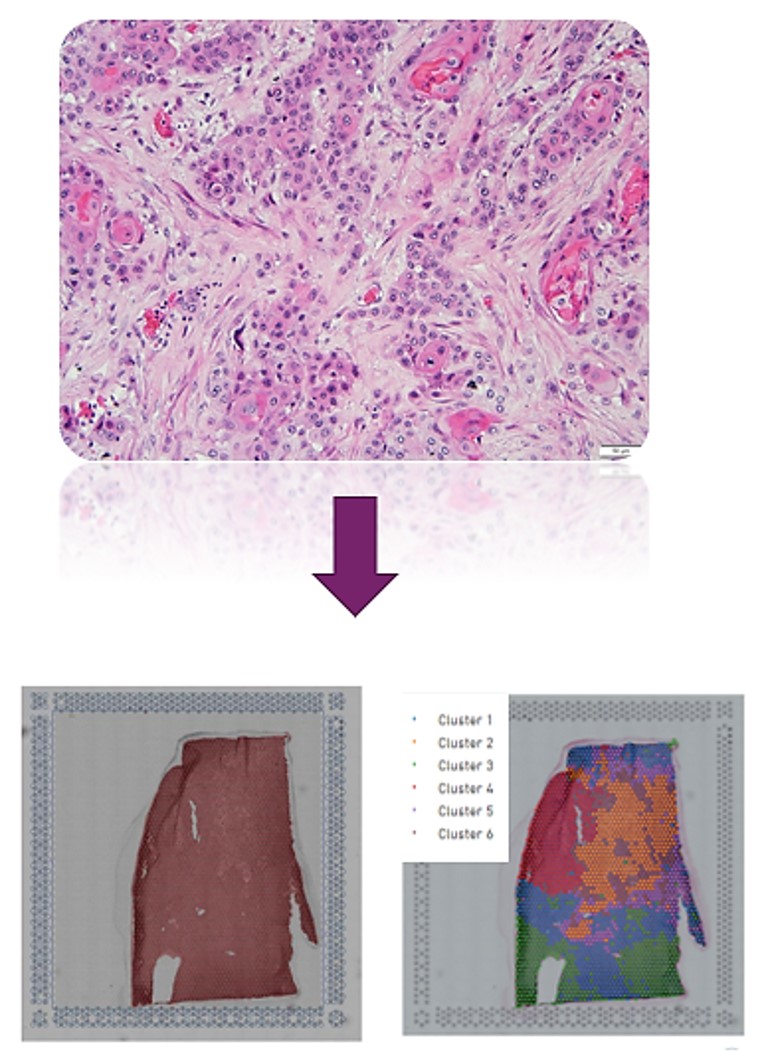Image of bladder cancer metastasis (up) and spatial transcriptional profiling of tumor and its tumor microenvironment (bottom)