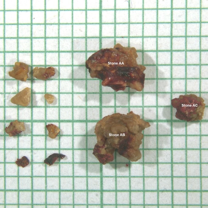 Image of different sized kidney stones